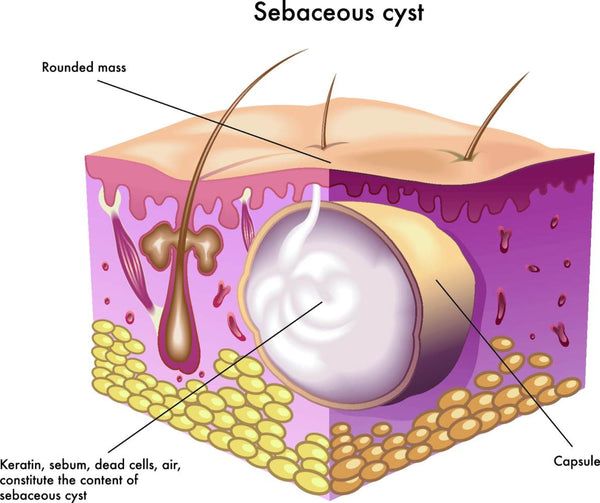 Sebaceous Cyst: Causes, Symptoms & Treatment Options